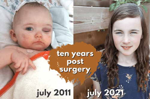 ten years after surgery: SAGITTAL CRANIOSYNOSTOSIS